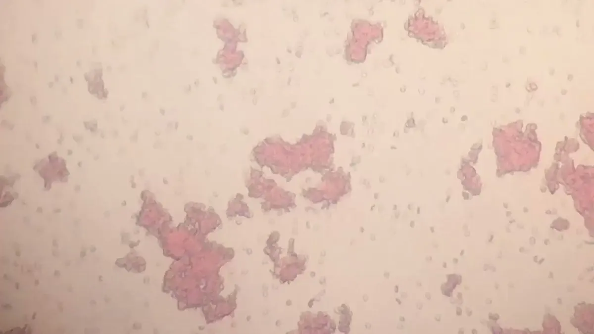Direct Coombs Test