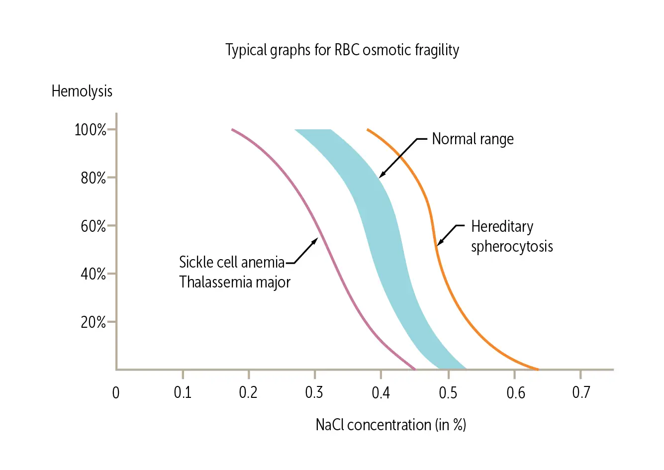 Osmotic Fragility Test: Diagnosis of Hereditary Spherocytosis