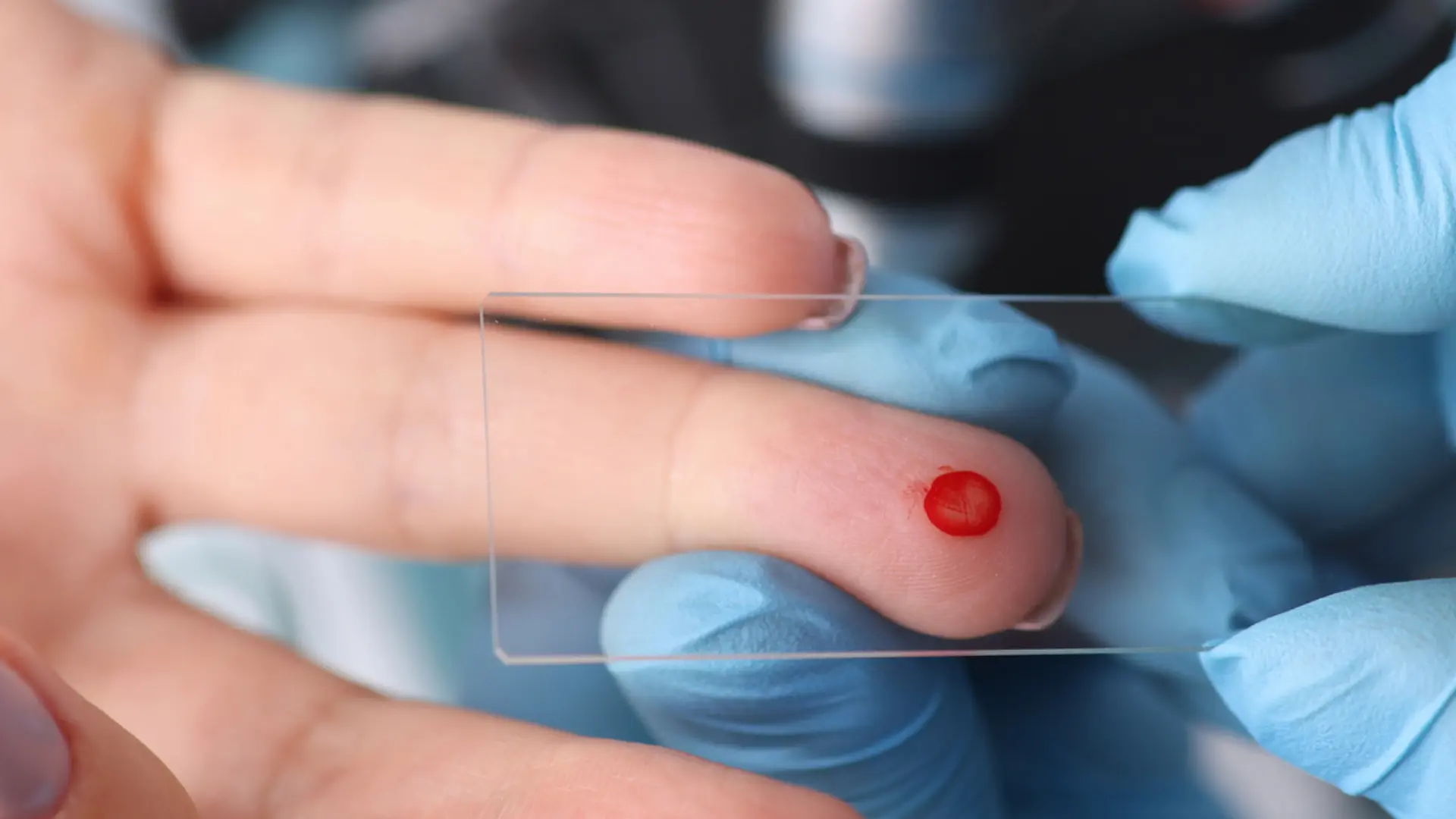 Staining of Peripheral Blood Smear