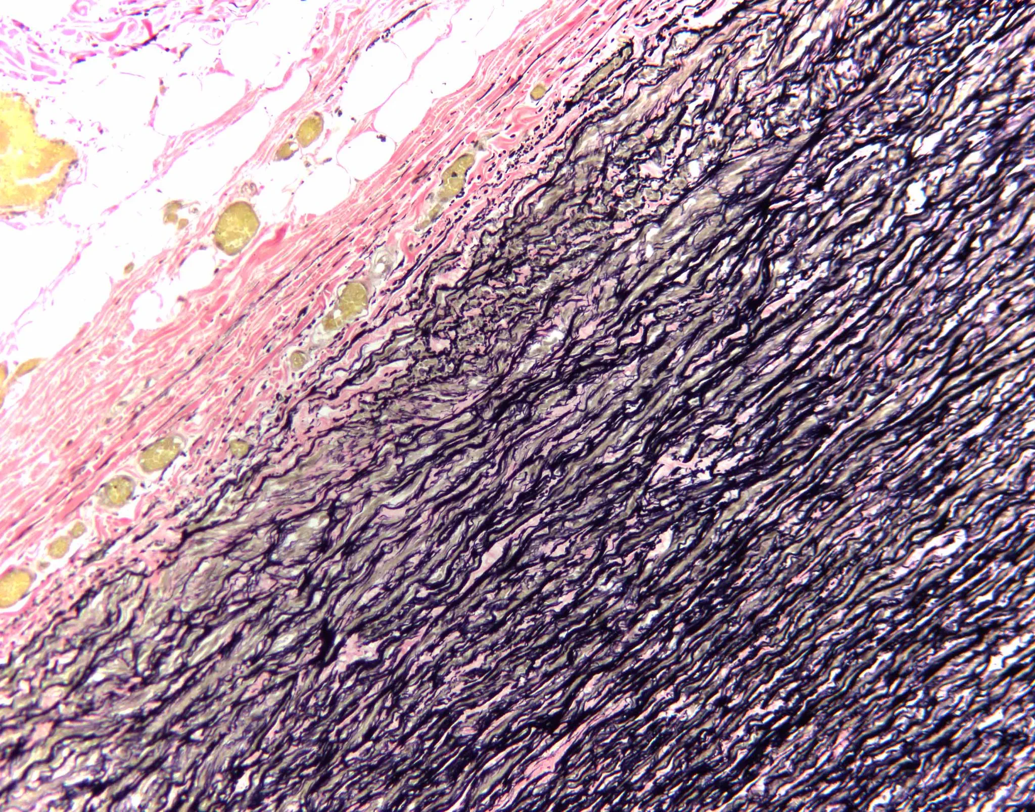 Verhoeff’s Stain